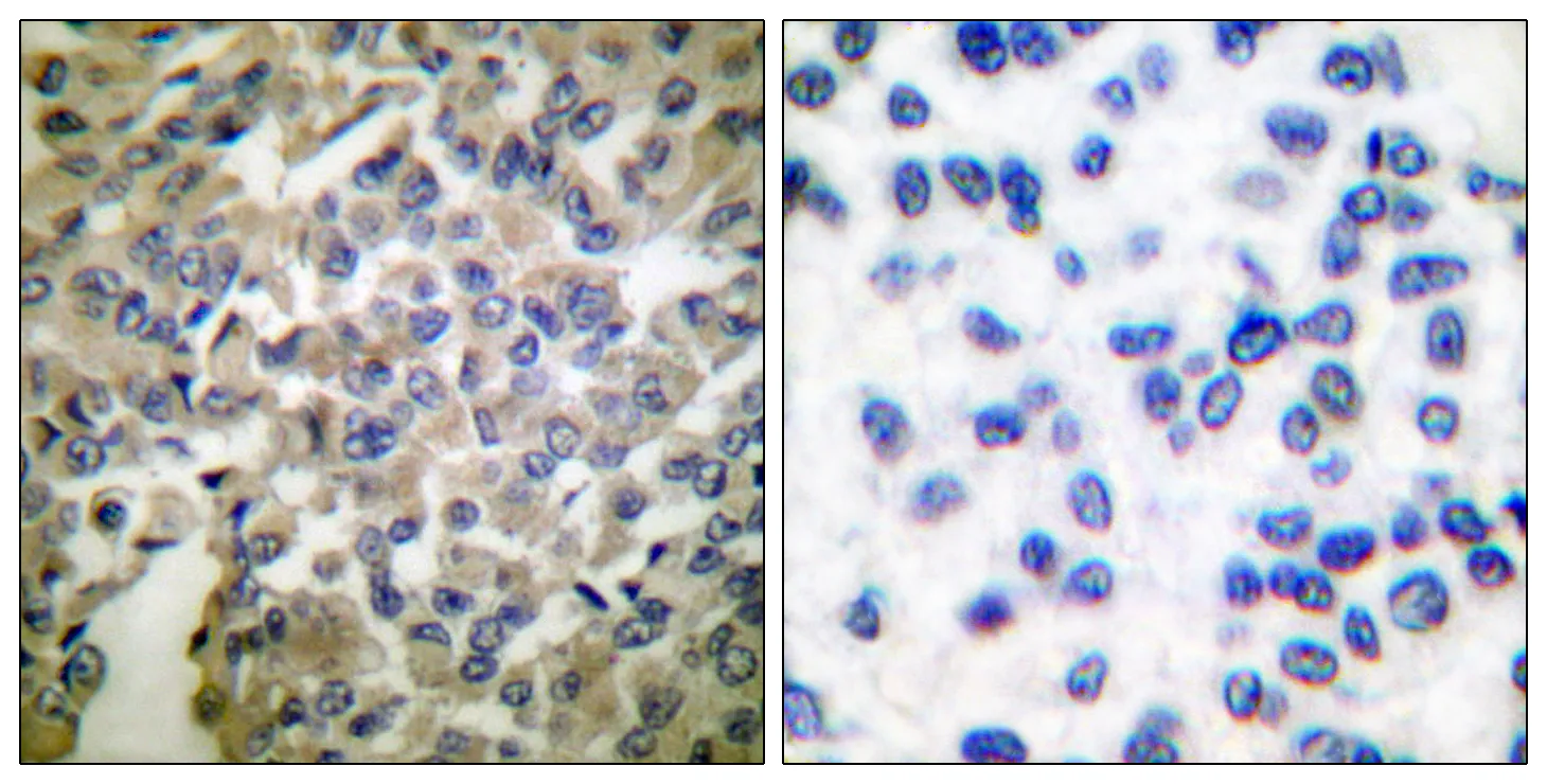 Immunohistochemistry analysis of paraffin-embedded human breast carcinoma tissue, using Synaptotagmin Antibody. The picture on the right is blocked with the synthesized peptide.