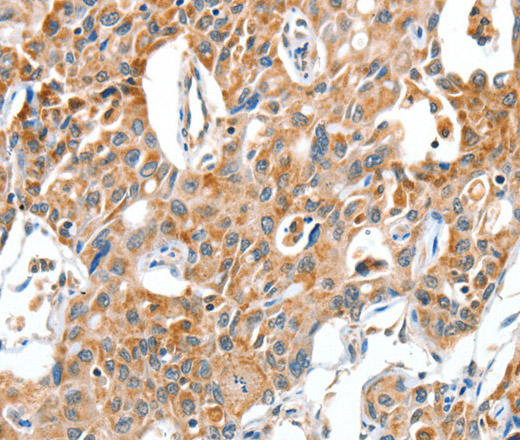 Western Blot analysis of Human brain malignant glioma Immunohistochemistry of paraffin-embedded Human tissue, MCF7, Raji and Lovo cell using BAX Polyclonal esophagus cancer using BAX Polyclonal Antibody at dilution Antibody at dilution of 1:300 of 1:30