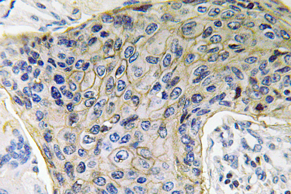 Immunohistochemistry analysis of AQP4 antibody in paraffin-embedded human lung carcinoma tissue.