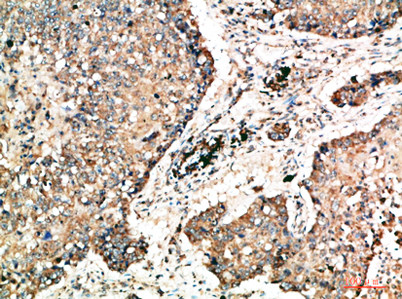 Immunohistochemical analysis of paraffin-embedded human-lung-cancer, antibody was diluted at 1:200