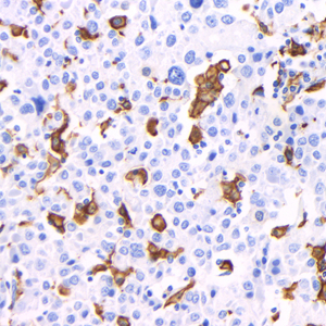 IHC analysis of IBA-1 . Sample: Human liver cancer , 4% PFA 12-24h. Antigen retrieval: TE buffer , 98℃ 20 min. Blocking buffer: 3% BSA in PBS , RT, 30min. Primary antibody: 1: 1000, 4℃ overnight. Secondary antibody: HRP Goat Anti-Mouse lgG , 1: 200 RT 1h.