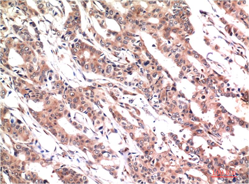Immunohistochemical analysis of paraffin-embedded Human Breast Carcinoma Tissue using phospho-Stat3 Y705 Mouse mAb diluted at 1:200.