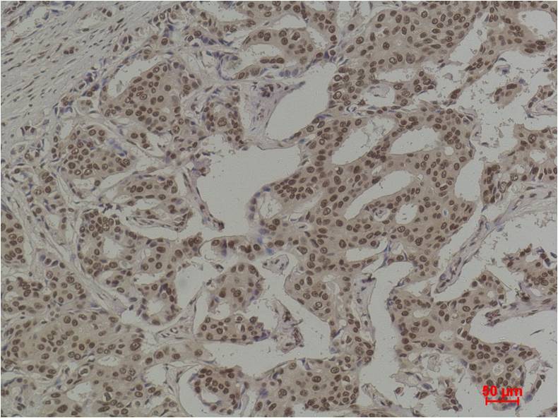 Immunohistochemical analysis of paraffin-embedded Human Breast Carcinoma using  COX2/Cyclooxygenase 2 Mouse mAb diluted at 1:100.