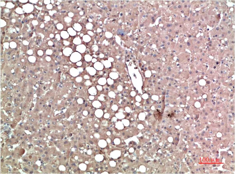 Immunohistochemistry analysis of paraffin-embedded Human Liver Carcinoma Tissue using Prealbumin (CL0290) antibody.High-pressure and temperature Sodium Citrate pH 6.0 was used for antigen retrieval.