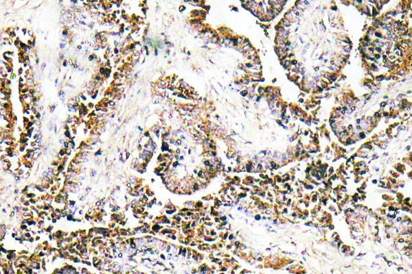Immunohistochemistry analysis of PPT1 antibody in paraffin-embedded human prostate carcinoma tissue.