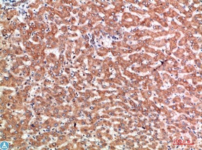Immunohistochemical analysis of
 paraffin-embedded human-liver-cancer, 
antibody was diluted at 1:200.