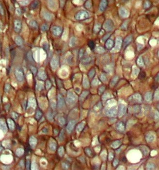 Immunohistochemistryof paraffin-embedded human breast carcinoma tissue using Phospho-ERBB2-Y1248 antibody.