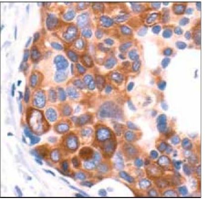 Immunohistochemical analysis of paraffin-embedded human breast carcinoma, showing cytoplasmic localization, using Phospho-Acetyl-CoA Carboxylase (Ser79) Antibody.