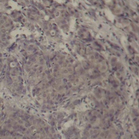 Immunohistochemical analysis of paraffin-embedded human breast carcinoma tissue using Phospho-CREB1-S142 antibody.