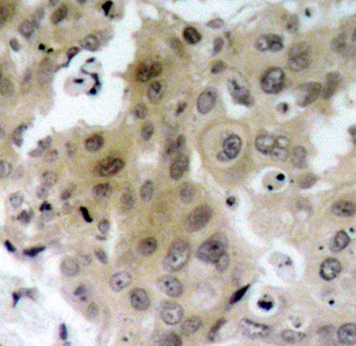 Immunohistochemical analysis of paraffin-embedded human breast carcinoma tissue using Phospho-VEGFR 2 (Tyr1175) antibody.