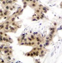 Immunohistochemical analysis of paraffin-embedded human breast carcinoma tissue using Phospho-NFKB-p50 (Ser893) antibody.