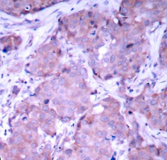 Immunohistochemical analysis of paraffin-embedded human breast carcinoma tissue, using Phospho-PTEN (Ser380) antibody