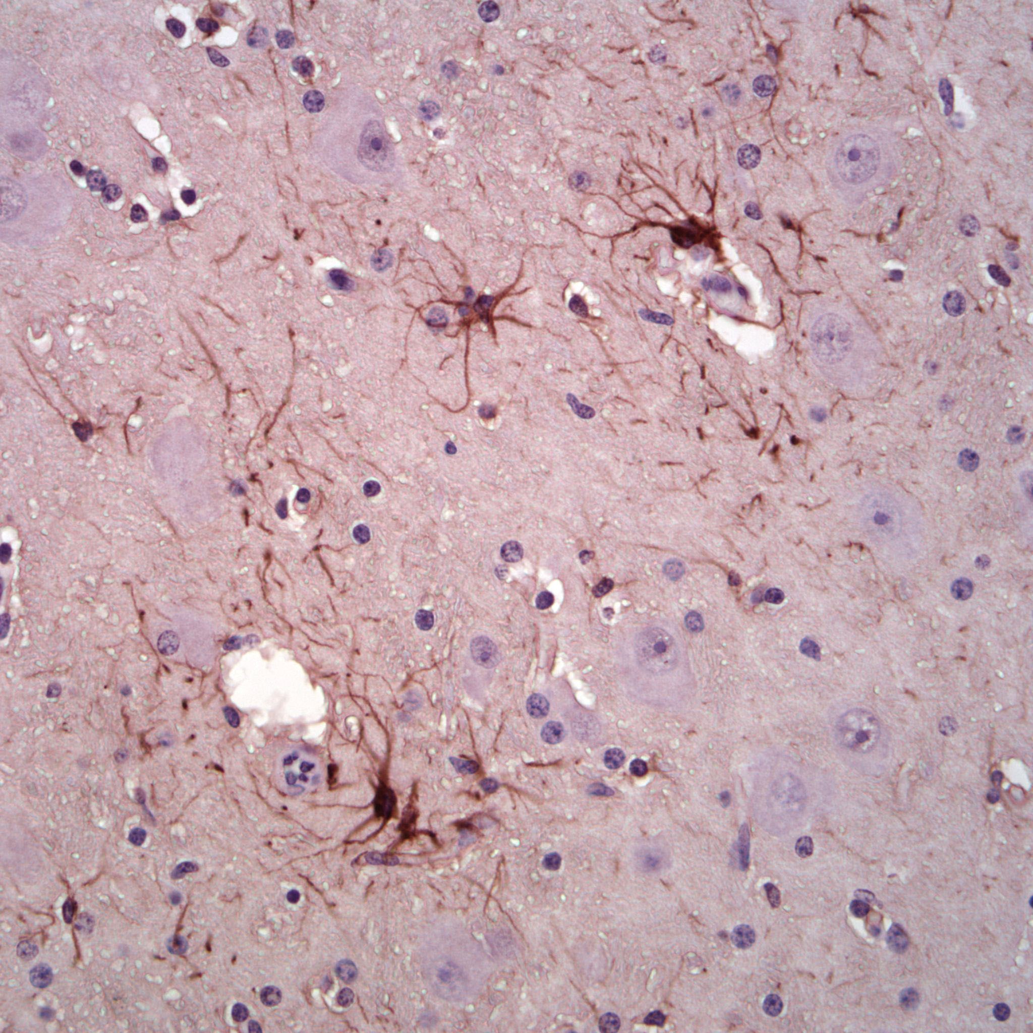 This is one of a series of formalin fixed paraffin embedded horse brain samples .The brains from this series were removed whole, sliced incompletely cross ways and fixed over a 10-20 day period. The whole brain was put in a large necropsy specimen bucket containing 1-2 gallons of fixative, and after 24 hours, the formalin was poured off and then fresh formalin was added. The samples were fixed and embedded in paraffin in 2007 and sections were kept at room temperature until 2011. The sections were processed for antigen retrieval by boiling in pH=6 Citrate buffer for 10 min. Primary incubation with 5C10 was for 1 hour at 37°C, and secondary antibody incubation and color reaction was performed using the Vector mouse ABC kit.