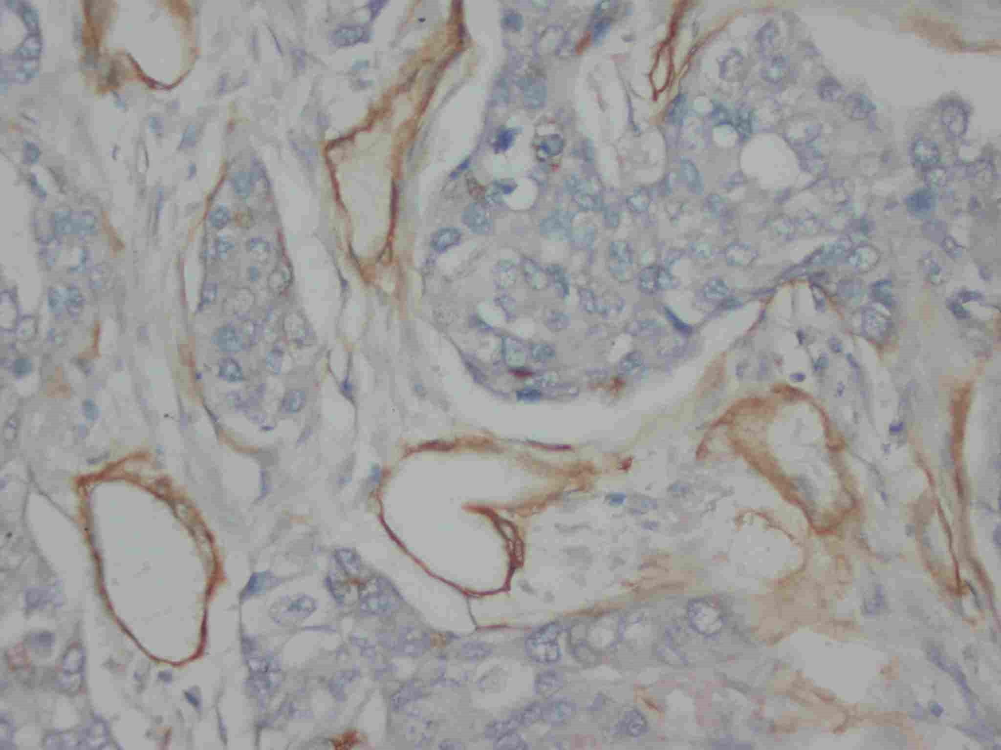 Anti-Collagen, Type IV antibody (monoclonal), IHC(P)
IHC(P): Human Mammary Cancer Tissue