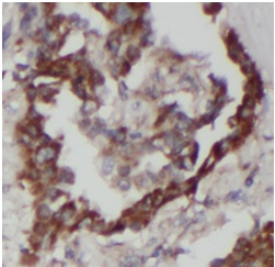 Immunohistochemistry of paraffin-embedded
human lung cancer using (RICTOR
antibody) at dilution of 1:100