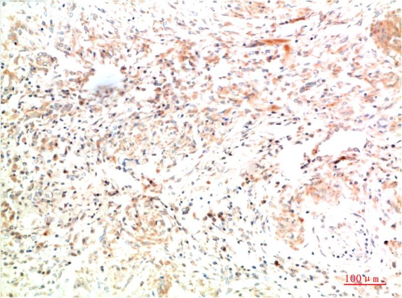 Immunohistochemical analysis of paraffin-embedded Human Lung Carcinoma Tissue using Collagen II Mouse mAb diluted at:200.