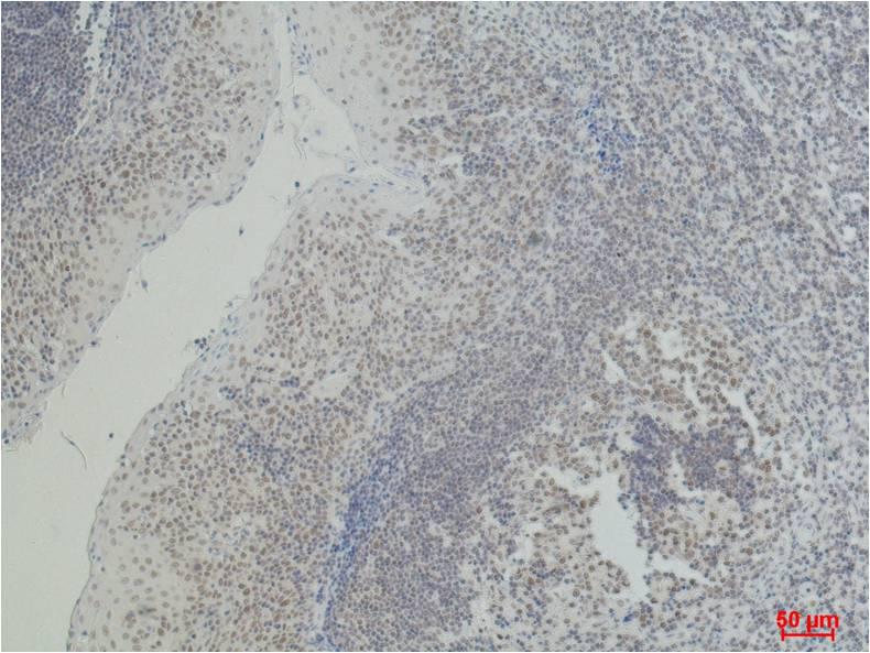 Immunohistochemical analysis of paraffin-embedded Human Tonsil Caricnoma using CD2 Mouse mAb diluted at:500.