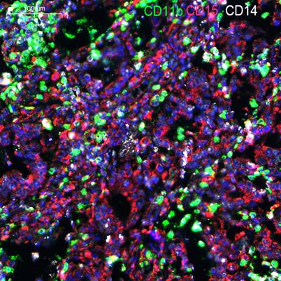 Fluorescence multiplex immunohistochemical analysis of normal human gastric cancer tissue (formalin-fixed paraffin-embedded section).The section was incubated in
3 rounds of staining; in the order of CD15 YT0726 (1/50 dilution), CD11b(1/50 dilution).