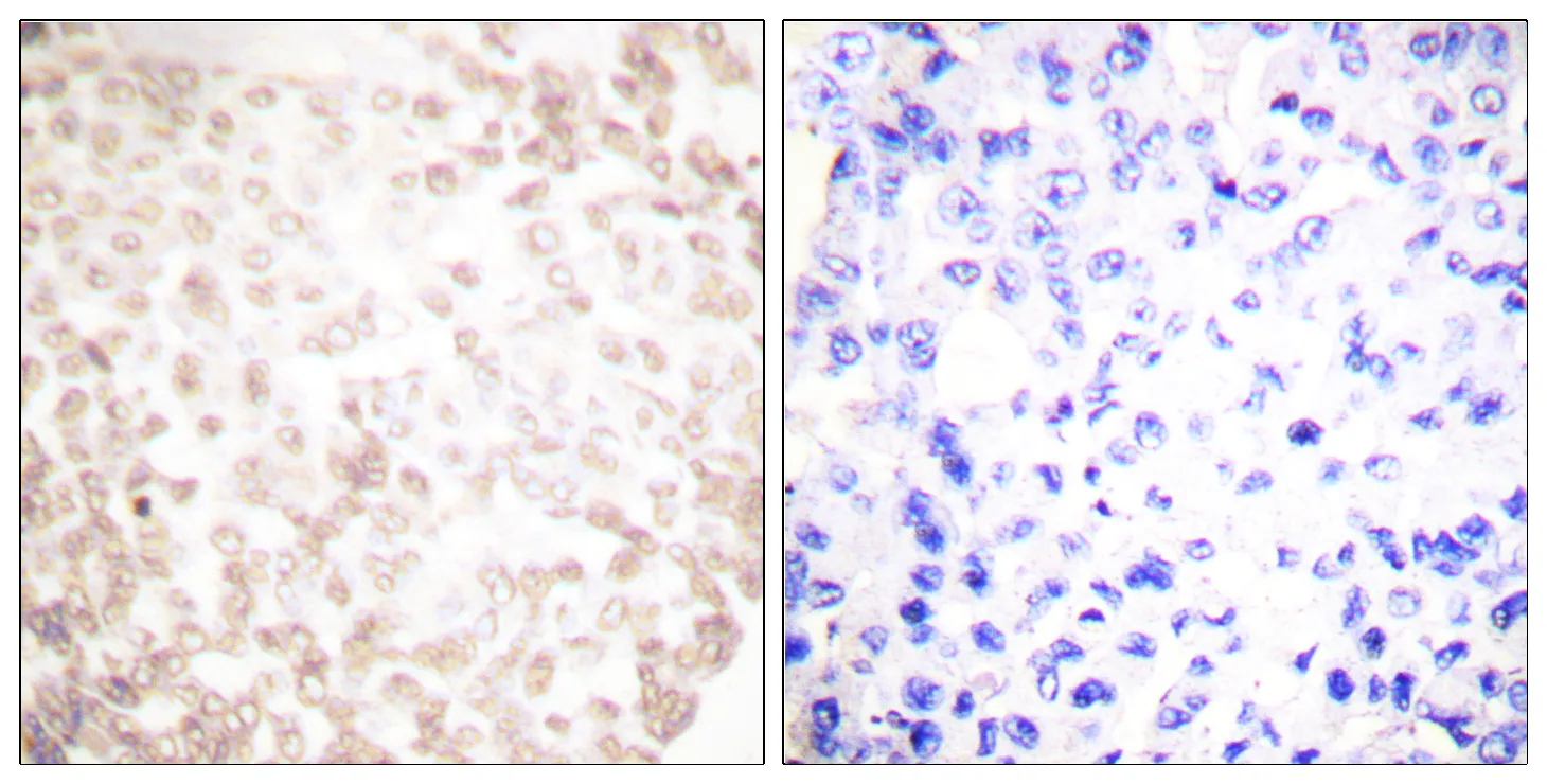 Immunohistochemistry analysis of paraffin-embedded human lung carcinoma tissue, using XRCC1 Antibody. The picture on the right is blocked with the synthesized peptide.