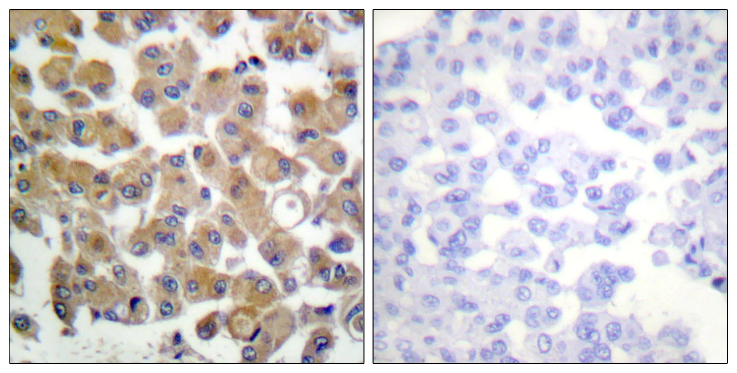 Immunohistochemistry analysis of paraffin-embedded human breast carcinoma
tissue, using TGF beta1 Antibody. The picture on the right is blocked with the
synthesized peptide.