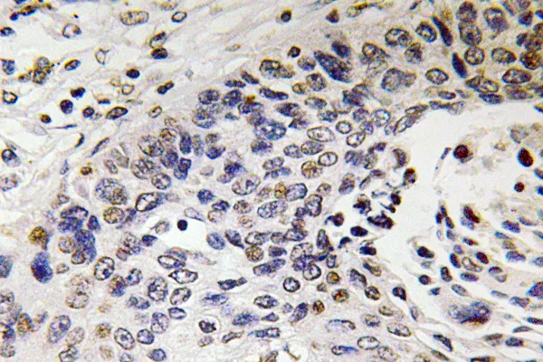 Immunohistochemistry analysis of NF-H antibody in paraffin-embedded human lung carcinoma tissue.