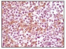 Immunohistochemical analysis of paraffin-embedded human glioma tissue, showing membrane localization using SNCA mouse mAb with DAB staining.
