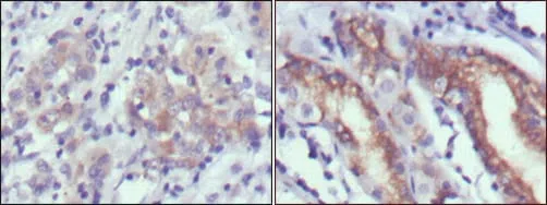 Immunohistochemical analysis of paraffin-embedded human gastric cancer (left) and normal gastric tissues (right) using CER1 mouse mAb with DAB staining.