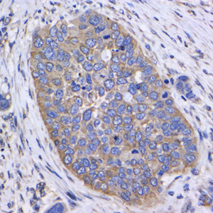 IHC analysis of GAPDH. Sample: Human esophageal cancer, 4% PFA 12-24h. Antigen retrieval: Citrate buffer , pressure cooker 2 min. Primary antibody: 1: 1000, 4℃ overnight. Secondary antibody: HRP conjugated Goat Anti-Rabbit lgG , 1: 200, RT, 1h.