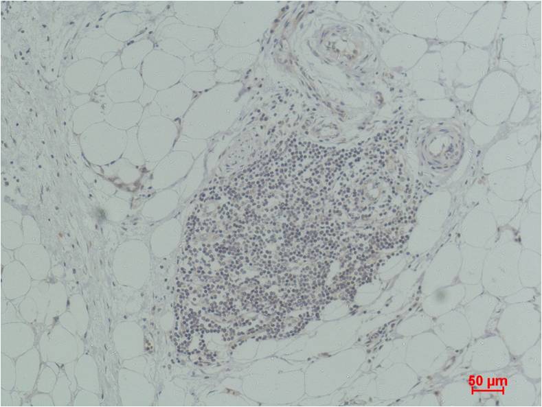 Immunohistochemical analysis of paraffin-embedded Human Breast Carcinoma using TNF a Rabbit pAb diluted at 1:200.