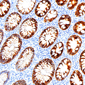 IHC analysis of COX2/Cyclooxygenase 2. Sample: Human colon, 4% PFA 12-24h. Antigen retrieval: TE buffer , pressure cooker 2 min. Primary antibody: 1: 200, 4℃ overnight. Secondary antibody: S-vision poly-HRP conjugated Goat Anti-Rabbit lgG , Ready to use, RT, 20min.
