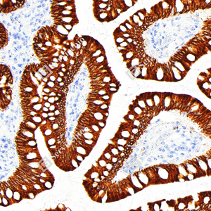 IHC analysis of COX2/Cyclooxygenase 2. Sample: Human colon, 4% PFA 12-24h. Antigen retrieval: TE buffer , pressure cooker 2 min. Primary antibody: 1: 200, 4℃ overnight. Secondary antibody: S-vision poly-HRP conjugated Goat Anti-Rabbit lgG , Ready to use, RT, 20min.
