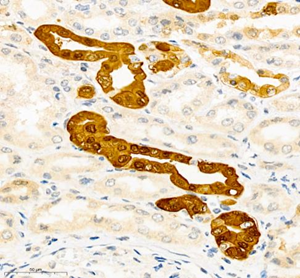 Immunohistochemistry of paraffin embedded human renal cancer using Calbindin Ab at dilution of 1: 1000