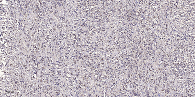 Immunohistochemical analysis of paraffin-embedded human small intestinal carcinoma tissue. 1,primary Antibody was diluted at 1:200(4° overnight). 2, Sodium citrate pH 6.0 was used for antigen retrieval(>98°C,20min). 3,Secondary antibody was diluted at 1:2