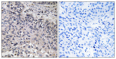 Immunohistochemistry analysis of paraffin-embedded human lung carcinoma tissue, using C1QC Antibody. The picture on the right is blocked with the synthesized peptide.