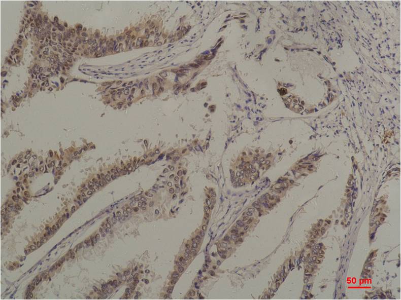 Immunohistochemical analysis of paraffin-embedded Human Breast Caricnoma using HSC70 Mouse mAb diluted at 1:200.