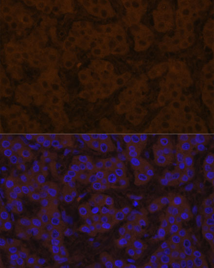 Immunofluorescence analysis of human liver cancer using TTR Rabbit Polyclonal Antibody at dilution of 1:100 (40x lens). Blue: DAPI for nuclear staining.