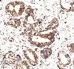 Immunohistochemistry of paraffin embedded human gastric cancer using COX IV at dilution of 1: 400
