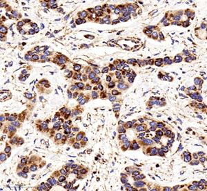 Immunohistochemistry of paraffin embedded human liver cancer using COX IV at dilution of 1: 400