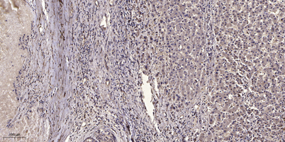 Immunohistochemical analysis of paraffin-embedded human liver cancer. 1, Antibody was diluted at 1:200(4° overnight). 2, Tris-EDTA,pH9.0 was used for antigen retrieval. 3,Secondary antibody was diluted at 1:200(room temperature, 45min).