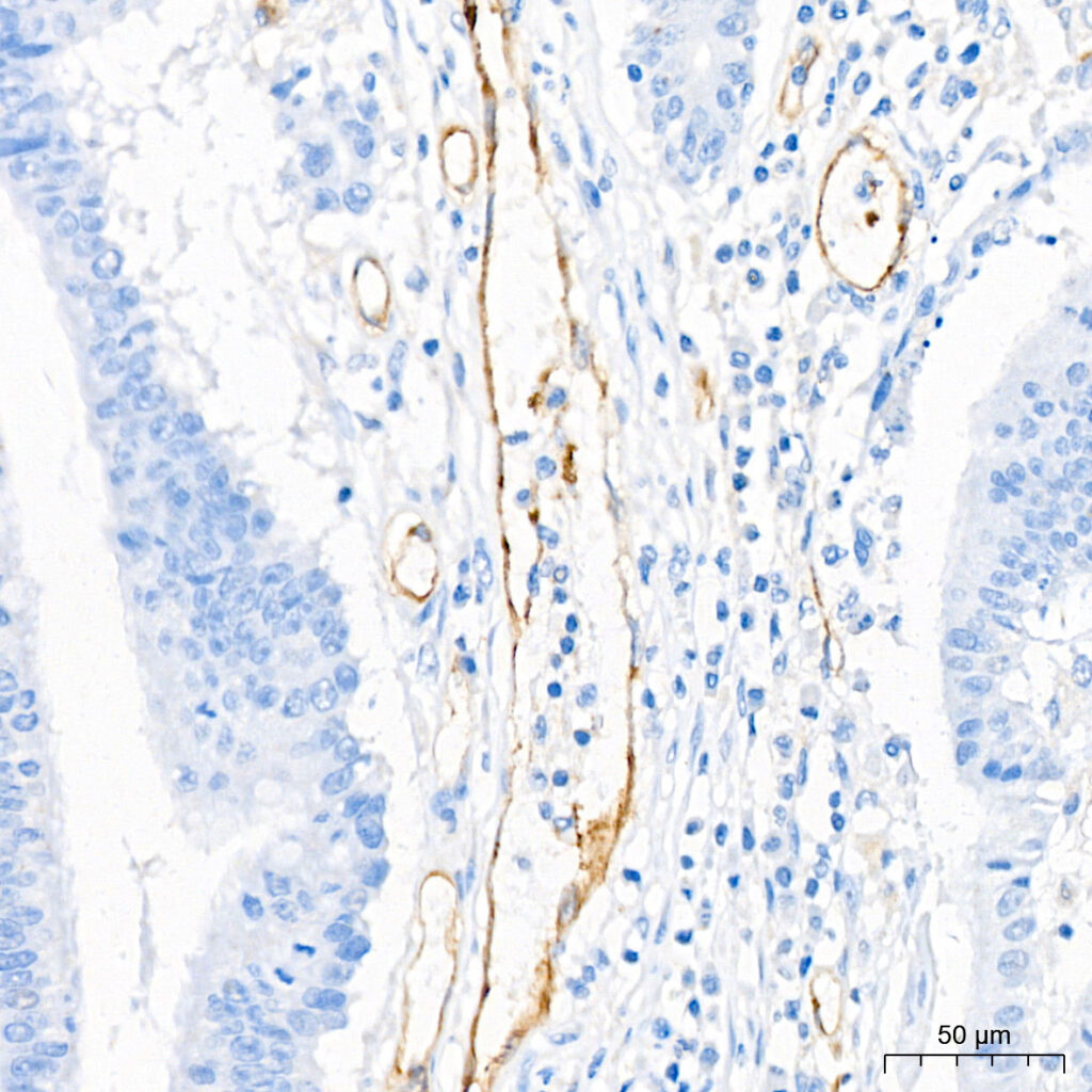 Immunohistochemistry analysis of paraffin-embedded Human colon carcinoma tissue using eNOS Rabbit mAb at a dilution of 1:200 (40x lens). High pressure antigen retrieval performed with 0.01M Citrate buffer (pH 6.0) prior to IHC staining.