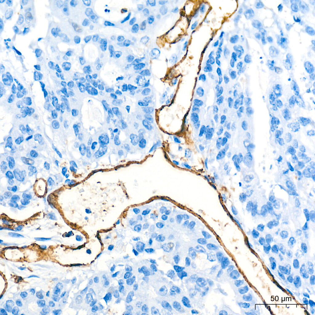 Immunohistochemistry analysis of paraffin-embedded Human colon carcinoma tissue using CD31/PECAM1 Rabbit mAb at a dilution of 1:500 (40x lens). High pressure antigen retrieval performed with 0.01M Tris-EDTA Buffer (pH 9.0) prior to IHC staining.
