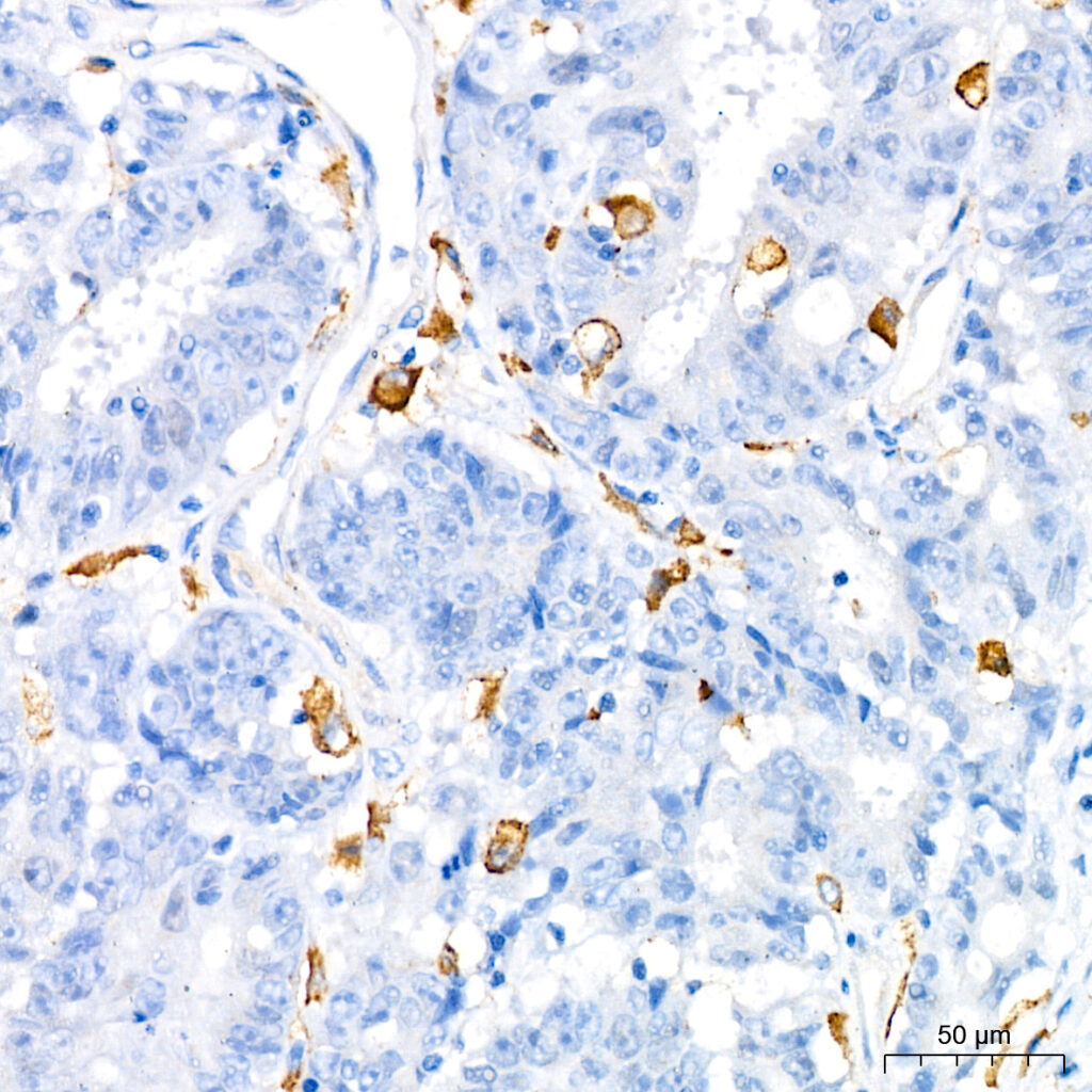 Immunohistochemistry analysis of paraffin-embedded Human colon carcinoma using TNF-α Rabbit pAb ) at dilution of 1:1000 (40x lens). High pressure antigen retrieval performed with 0.01M Citrate buffer (pH 6.0) prior to IHC staining.
