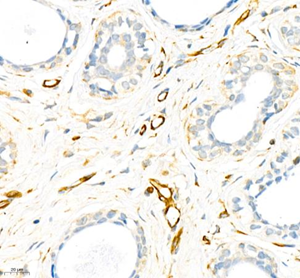 IHC analysis of Vimentin . Sample: Human breast cancer , 4% PFA 12-24h. Antigen retrieval: Citrate buffer ,98℃,20 min. Blocking buffer: 3% BSA in PBS , RT, 30min. Primary antibody: 1: 1500, 4℃ overnight. Secondary antibody: HRP Goat Anti-Rabbit lgG , 1: 200 RT 1h.