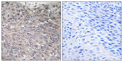 Immunohistochemistry analysis of paraffin-embedded human cervix carcinoma, using Inositol 1, 4, 5-trisphosphate R1 (Phospho-Ser1598/1588) Antibody. The picture on the right is blocked with the phospho peptide.