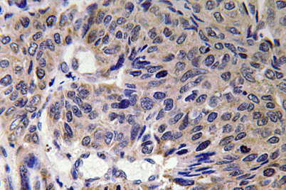Immunohistochemistry analysis of Mfn2 antibody in paraffin-embedded human lung carcinoma tissue.
