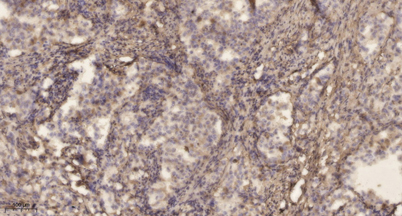 Immunohistochemical analysis of paraffin-embedded human lung cancer. 1, Antibody was diluted at 1:200(4° overnight). 2, Tris-EDTA,pH9.0 was used for antigen retrieval. 3,Secondary antibody was diluted at 1:200(room temperature, 45min).