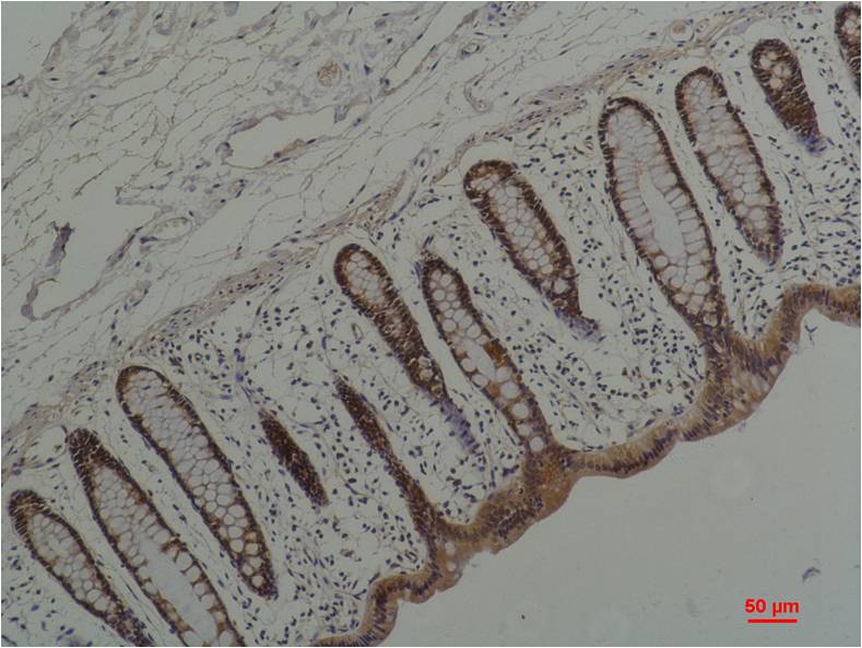Immunohistochemical analysis of paraffin-embedded Human Colon Caricnoma using  HSP90 α Mouse mAb diluted at 1:200.