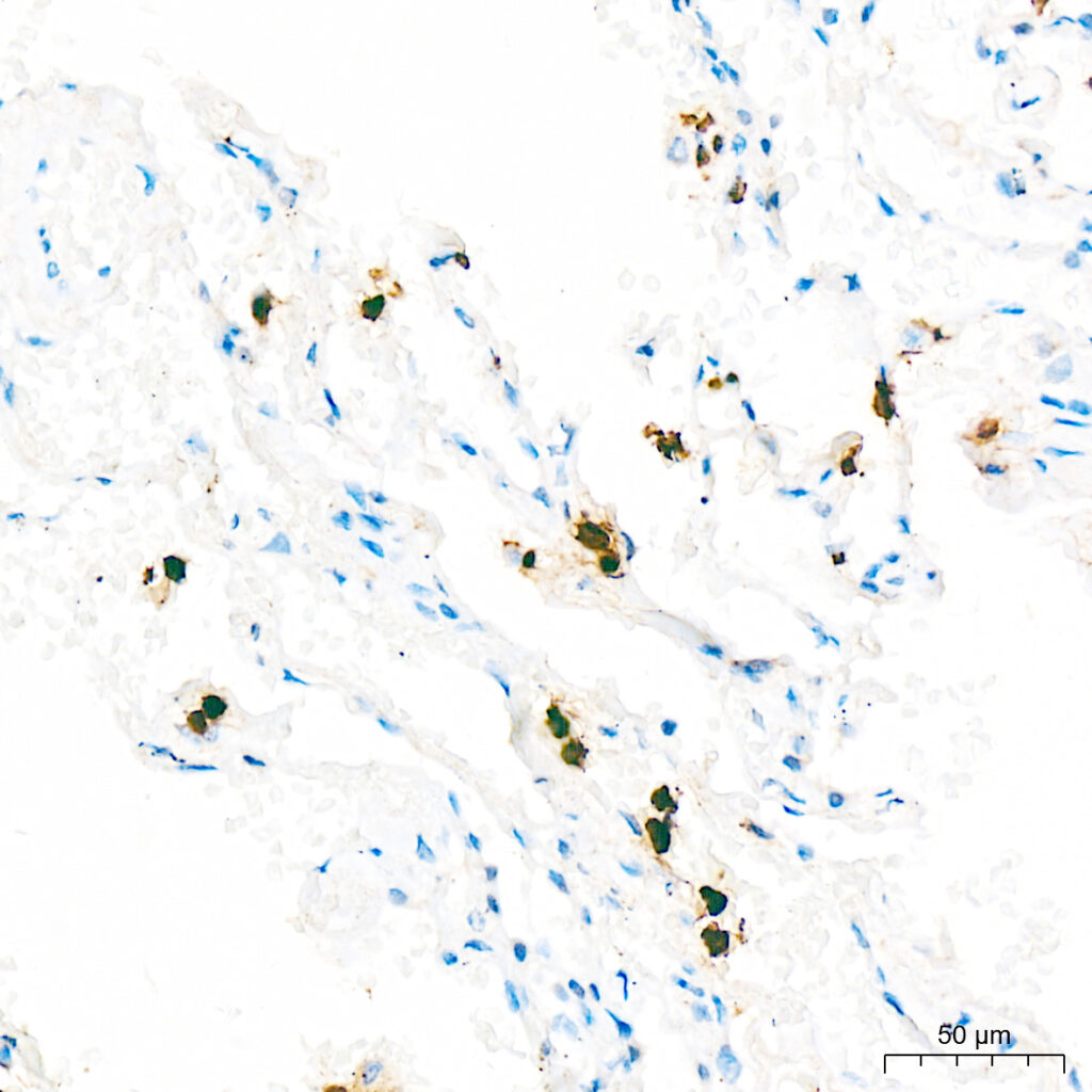 Immunohistochemistry analysis of paraffin-embedded Human lung tissue using Lipocalin-2/NGAL Rabbit pAb at a dilution of 1:900 (40x lens). High pressure antigen retrieval was performed with 0.01 M citrate buffer (pH 6.0) prior to IHC staining.