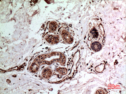 Immunohistochemical analysis of paraffin-embedded human-breast-cancer, antibody was diluted at 1:100