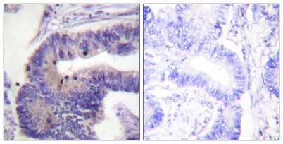 Immunohistochemistry analysis of paraffin-embedded human colon carcinoma tissue, using PDE4D Antibody. The picture on the right is blocked with the synthesized peptide.